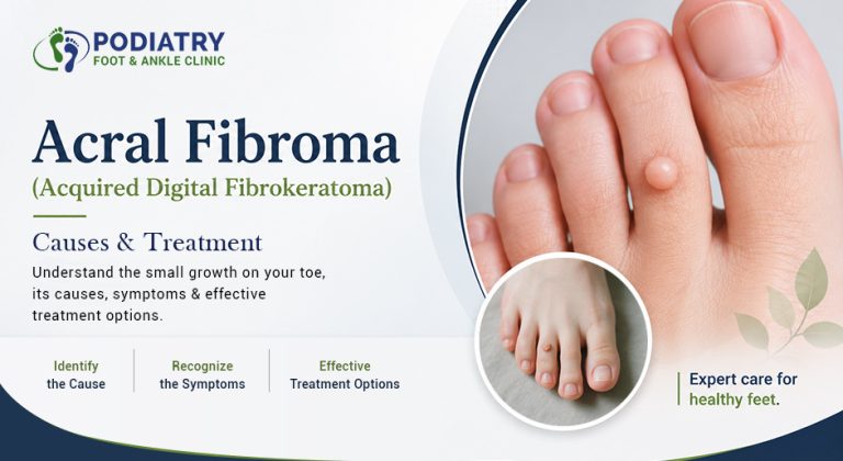 Acral Fibroma (Acquired Digital Fibrokeratoma)