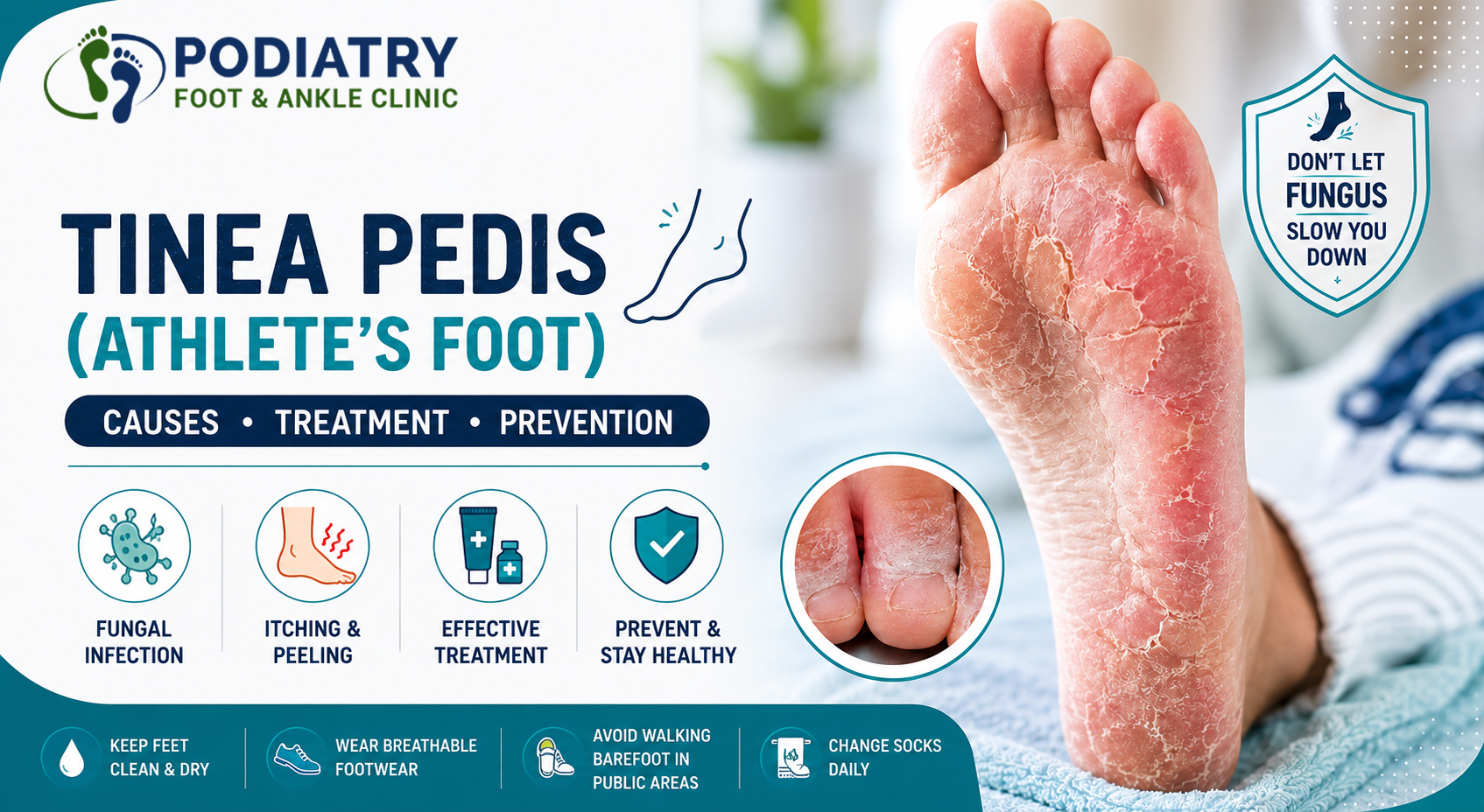 Tinea Pedis (Athlete’s Foot)